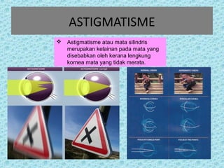 ASTIGMATISME 
 Astigmatisme atau mata silindris 
merupakan kelainan pada mata yang 
disebabkan oleh kerana lengkung 
kornea mata yang tidak merata. 
 