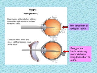 Imej terbentuk di 
hadapan retina 
Penggunaan 
kanta cembung 
membolehkan 
imej difokuskan di 
retina. 
 