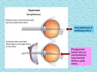 Imej terbentuk di 
belakang retina 
Penggunaan 
kanta cekung 
membolehkan 
imej kembali 
difokus pada 
retina 
 