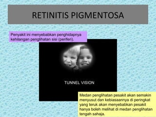 RETINITIS PIGMENTOSA 
Penyakit ini menyebabkan penghidapnya 
kehilangan penglihatan sisi (periferi). 
TUNNEL VISION 
Medan penglihatan pesakit akan semakin 
menyusut dan kebiasaannya di peringkat 
yang teruk akan menyebabkan pesakit 
hanya boleh melihat di medan penglihatan 
tengah sahaja. 
 