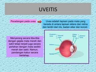 UVEITIS 
Peradangan pada uvea Uvea adalah lapisan pada mata yang 
berada di antara lapisan sklera dan retina 
dan terdiri dari iris, badan siliar dan koroid. 
Menyerang secara tiba-tiba 
dengan gejala mata merah dan 
sakit tetapi terjadi juga secara 
perlahan dengan mata sedikit 
merah dan sakit. Namun, 
pandangan kabur secara 
bertahap. 
 