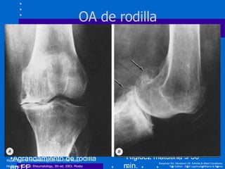 M8 osteoartrosis