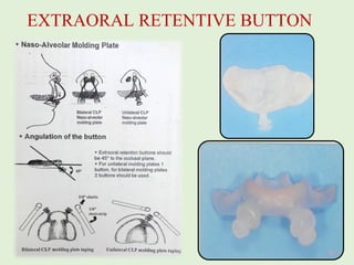 NASOALVEOLAR MOULDING AND PEDODONTIST | PPT
