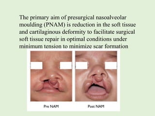 • Retraction of premaxilla.
• Alignment of cleft alveolar segments.
• Presurgical elongation of collumella
• Up-righting o...