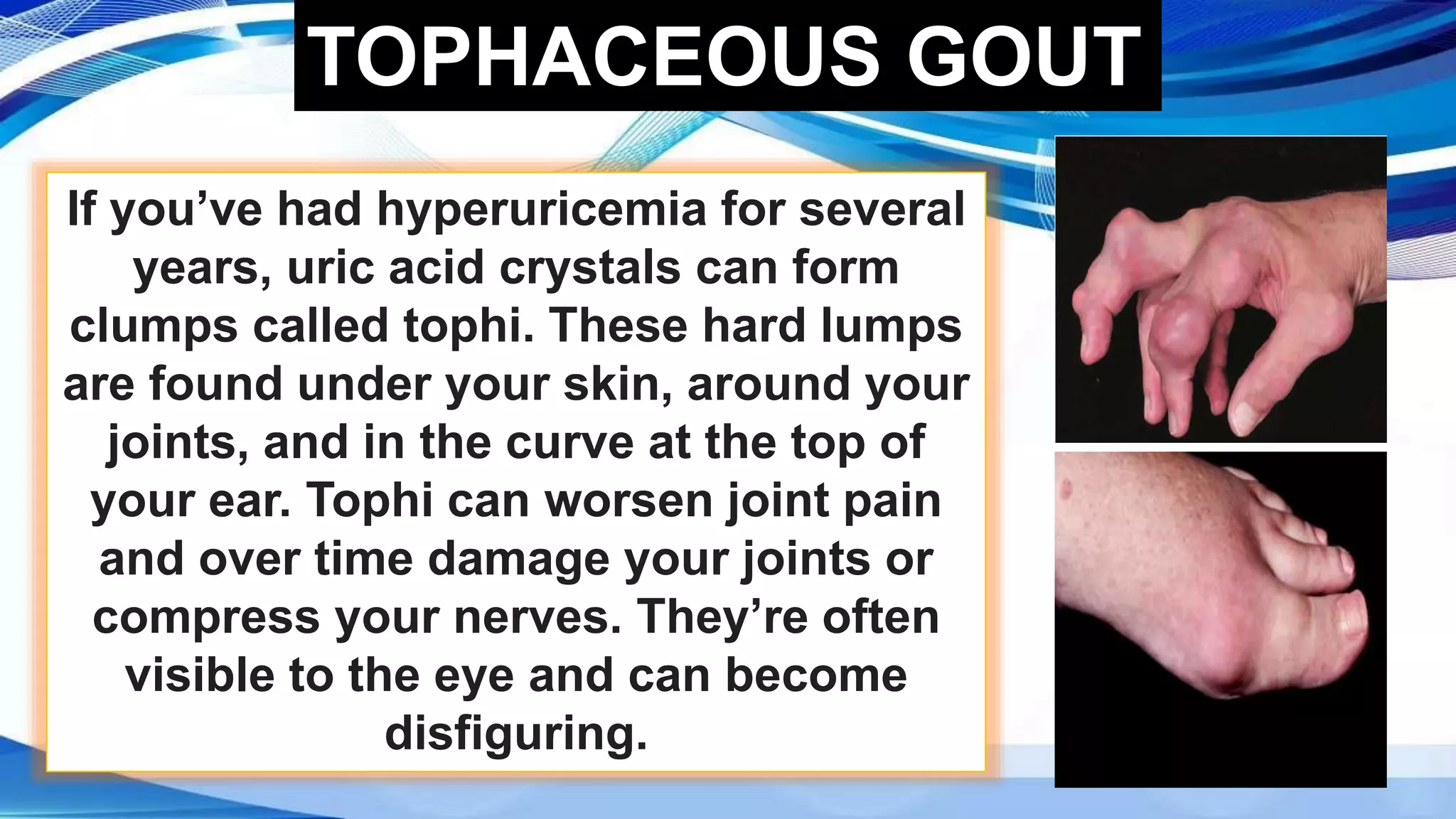 Uric acid and related Disorders | PPTX