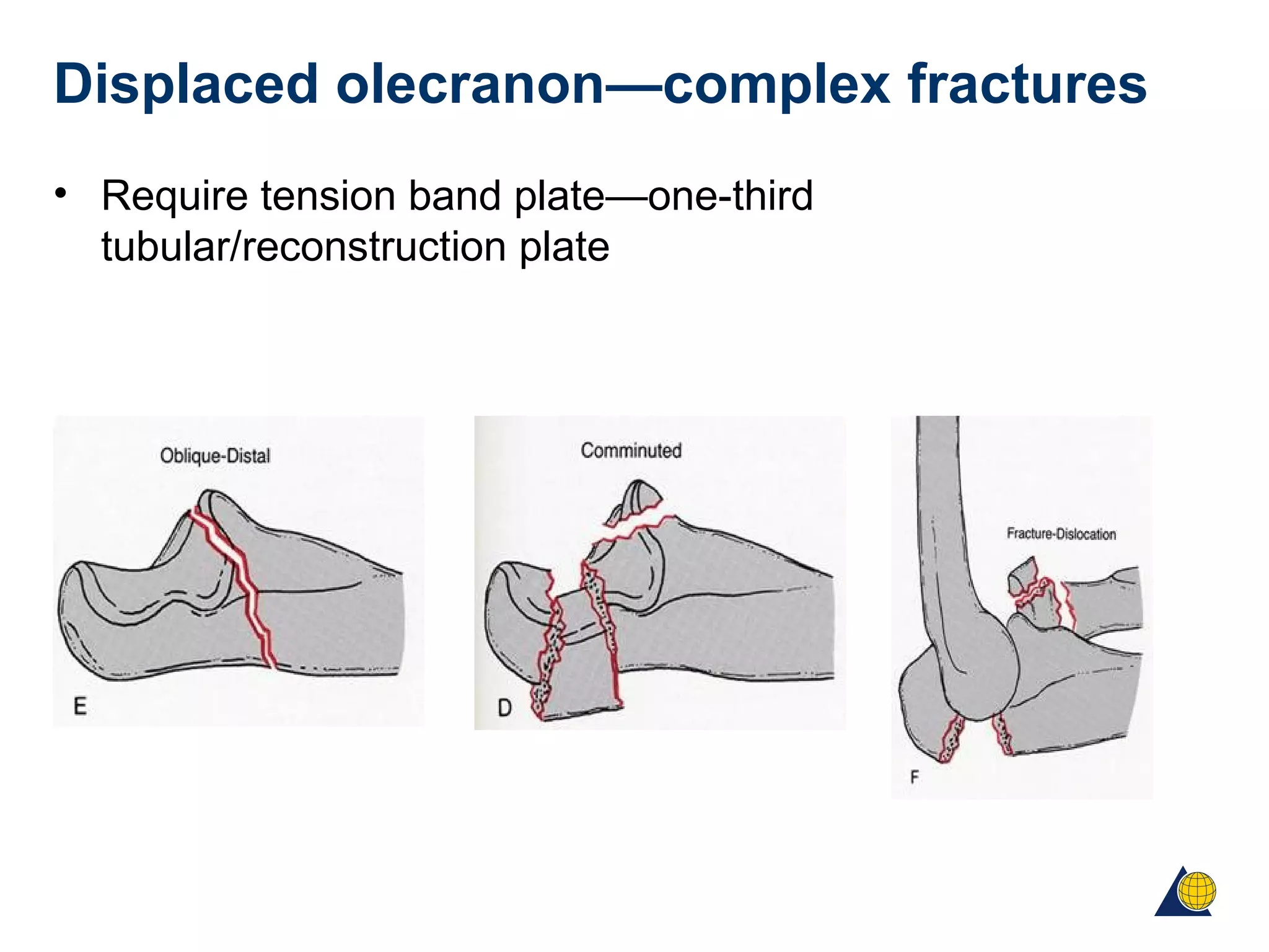 Displaced olecranon—complex fractures
• Require tension band plate—one-third
tubular/reconstruction plate
 