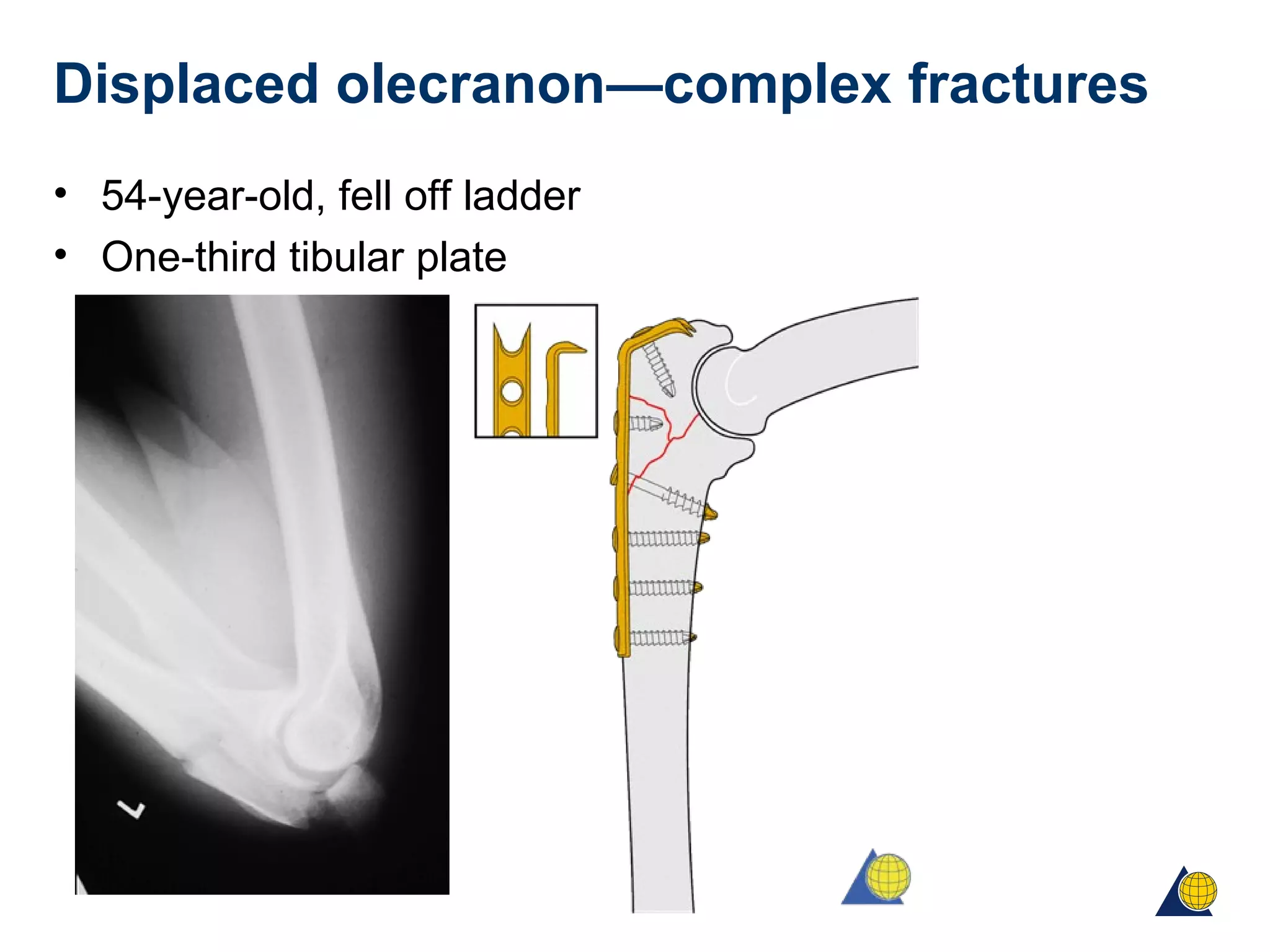 Displaced olecranon—complex fractures
• 54-year-old, fell off ladder
• One-third tibular plate
 