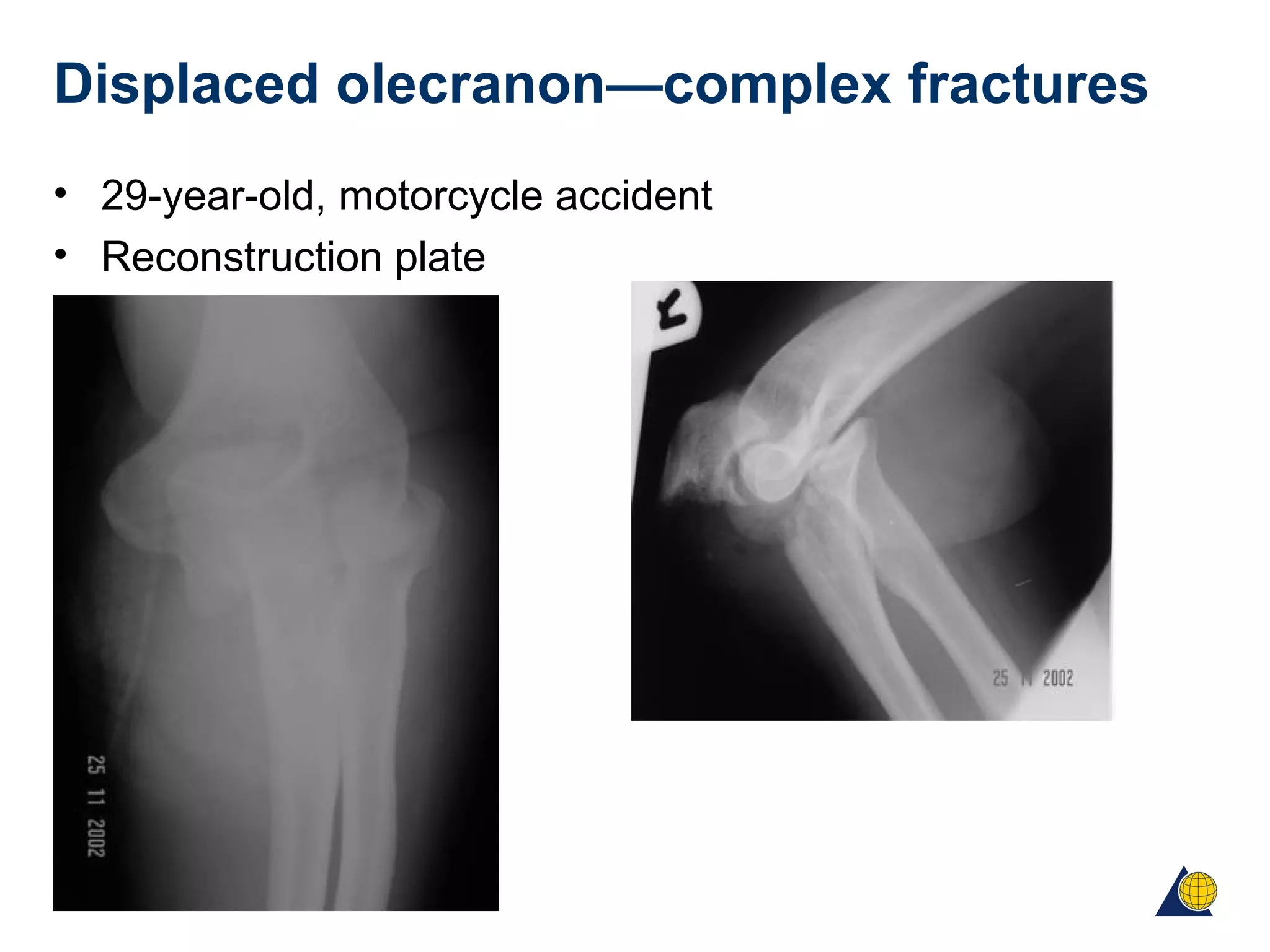 Displaced olecranon—complex fractures
• 29-year-old, motorcycle accident
• Reconstruction plate
 