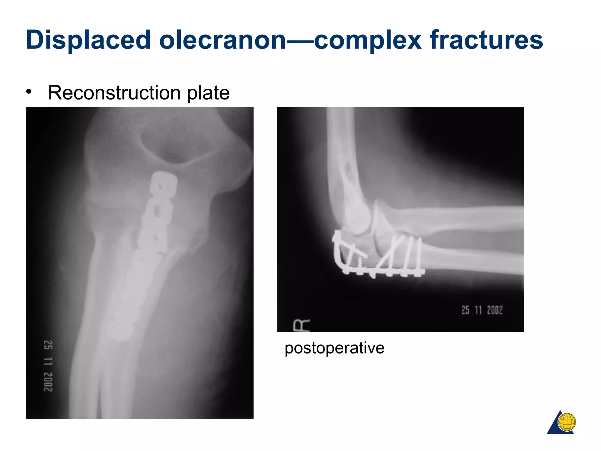 Displaced olecranon—complex fractures
• Reconstruction plate
postoperative
 
