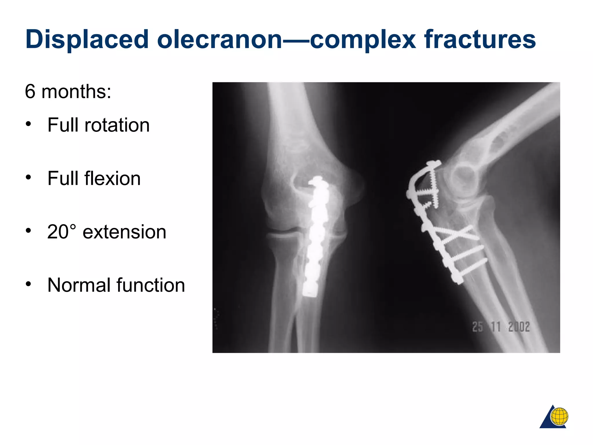 Displaced olecranon—complex fractures
6 months:
• Full rotation
• Full flexion
• 20° extension
• Normal function
 