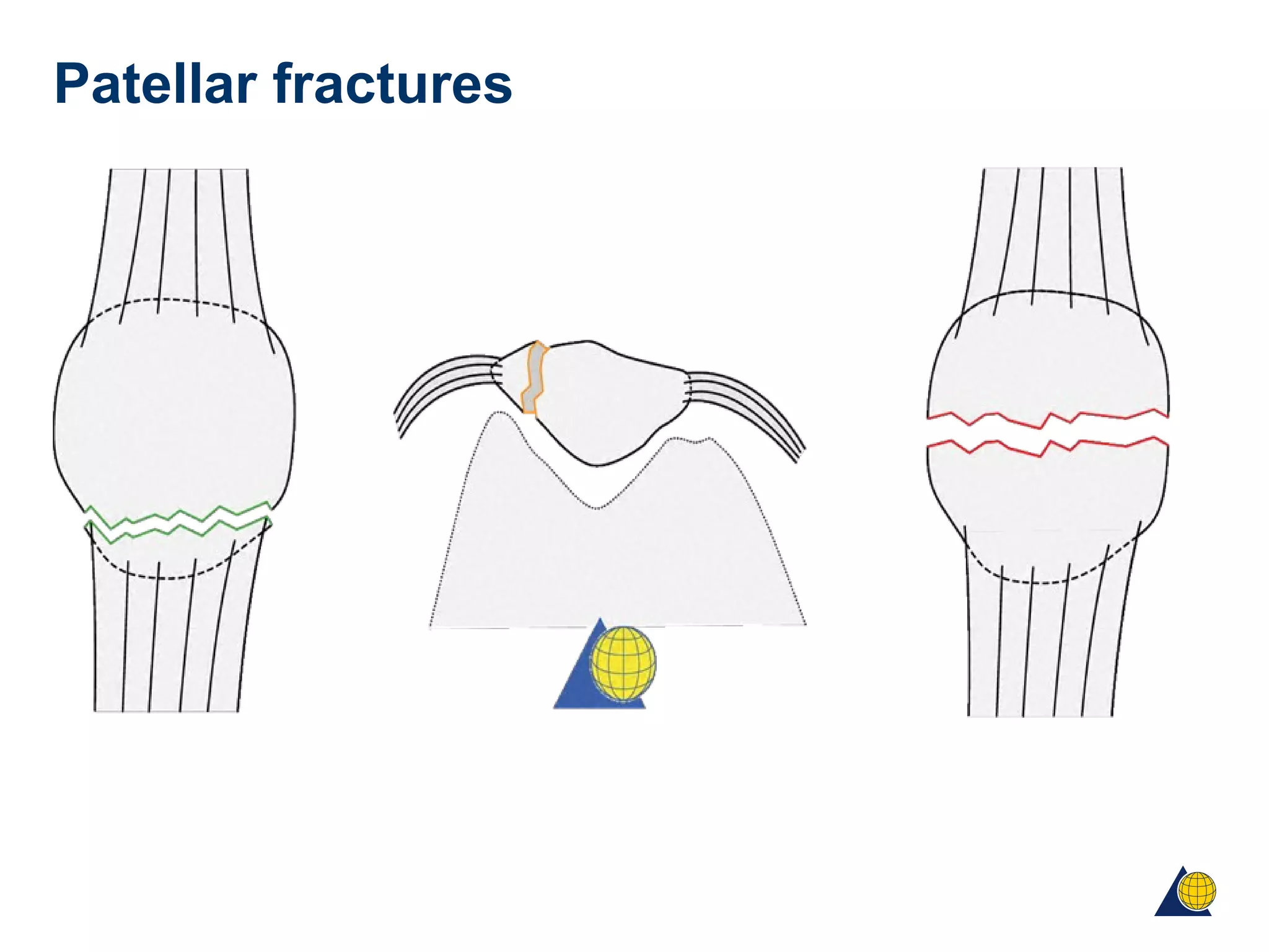 Patellar fractures
 