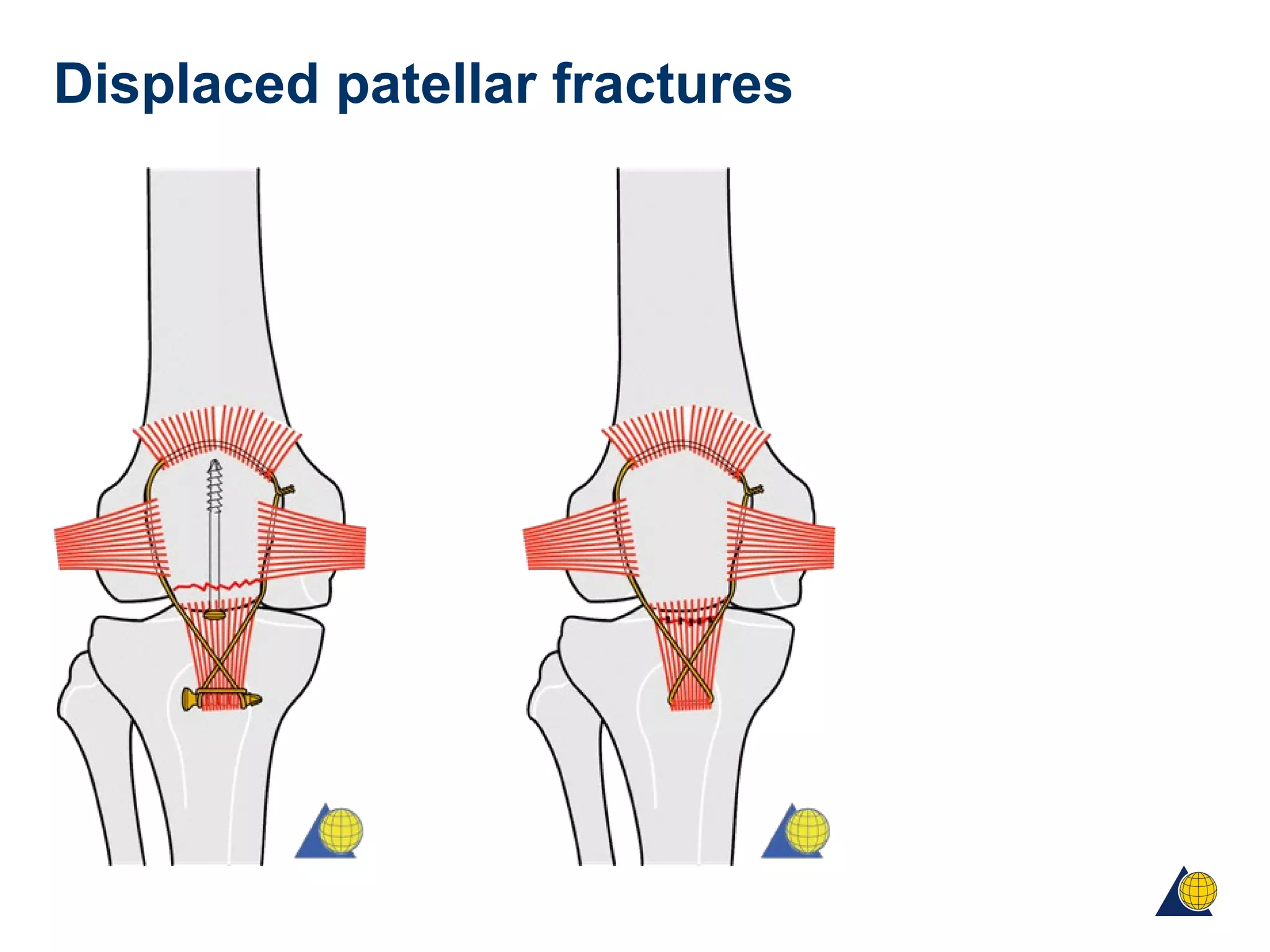 Displaced patellar fractures
 