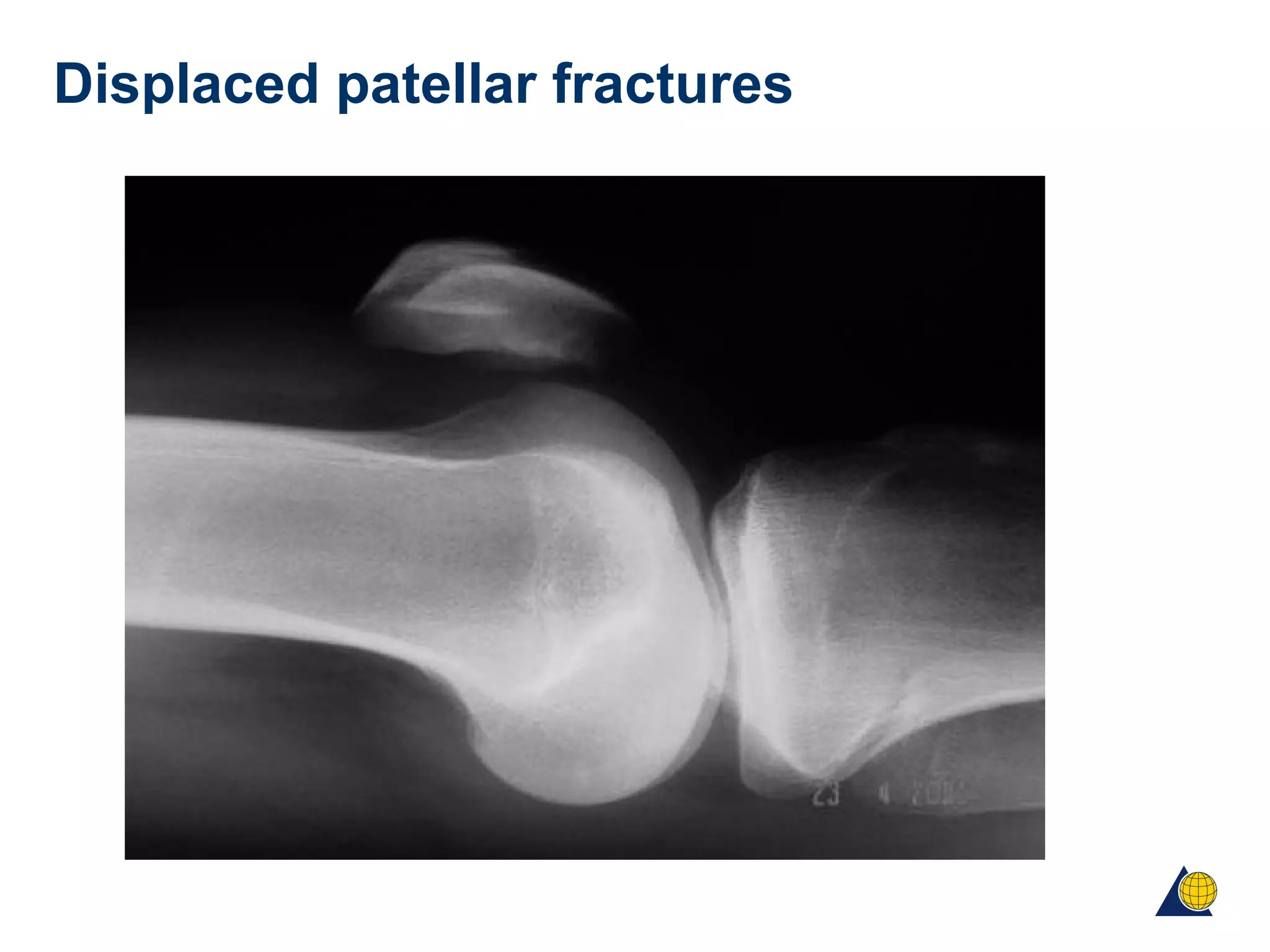 Displaced patellar fractures
 