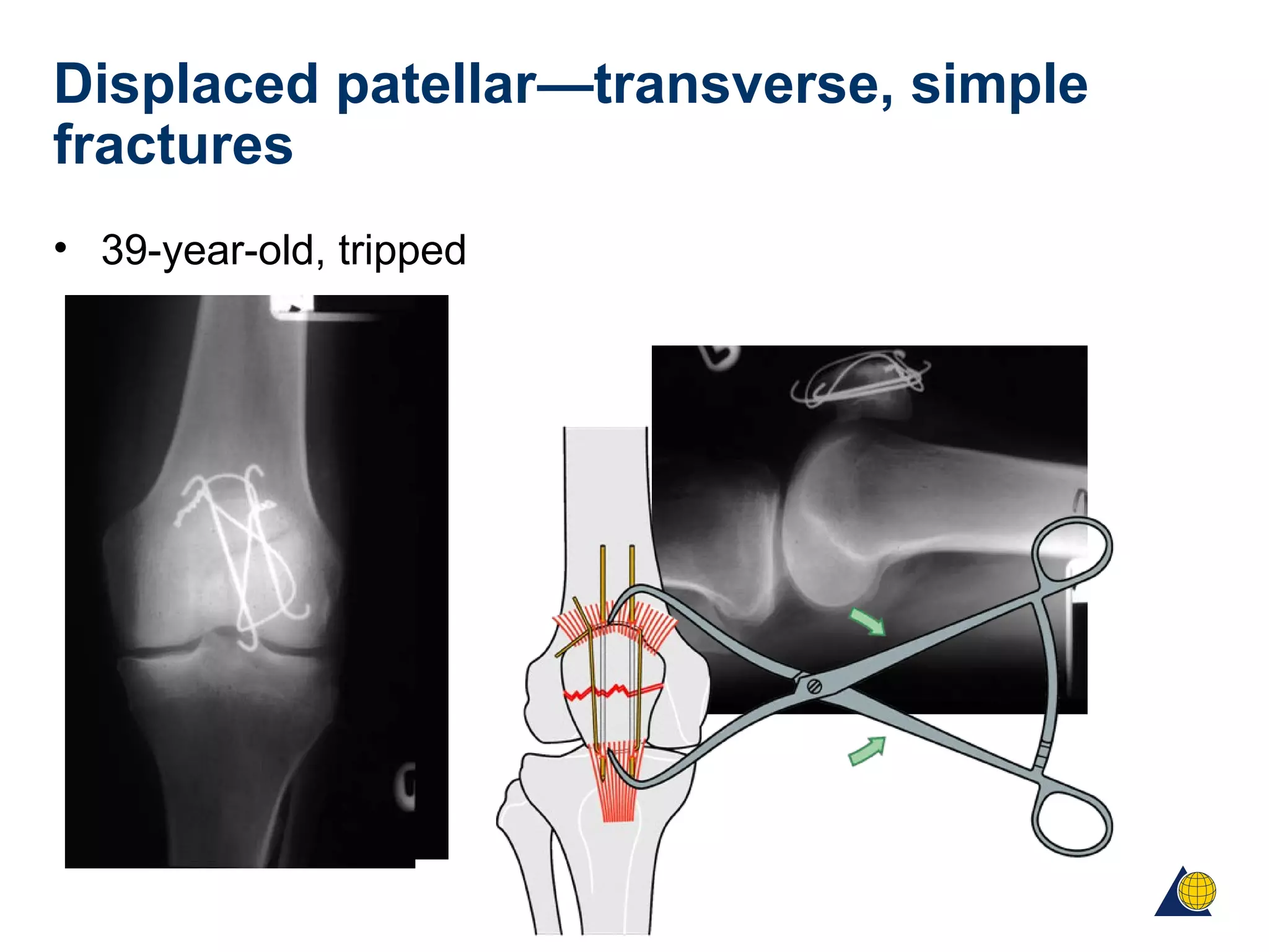 Displaced patellar—transverse, simple
fractures
• 39-year-old, tripped
 
