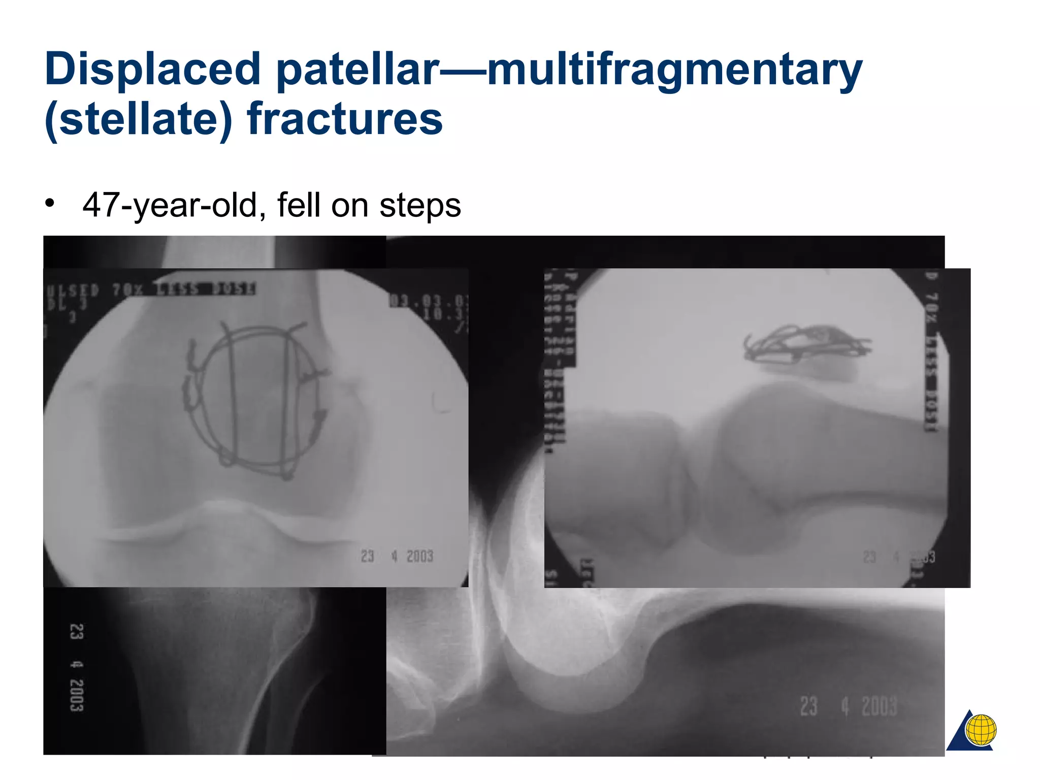 Displaced patellar—multifragmentary
(stellate) fractures
• 47-year-old, fell on steps
 