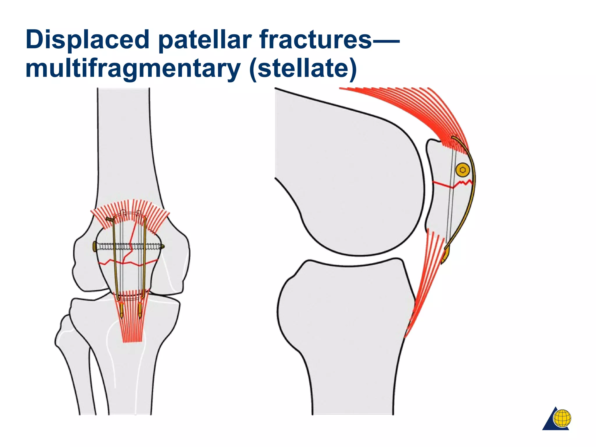 Displaced patellar fractures—
multifragmentary (stellate)
 