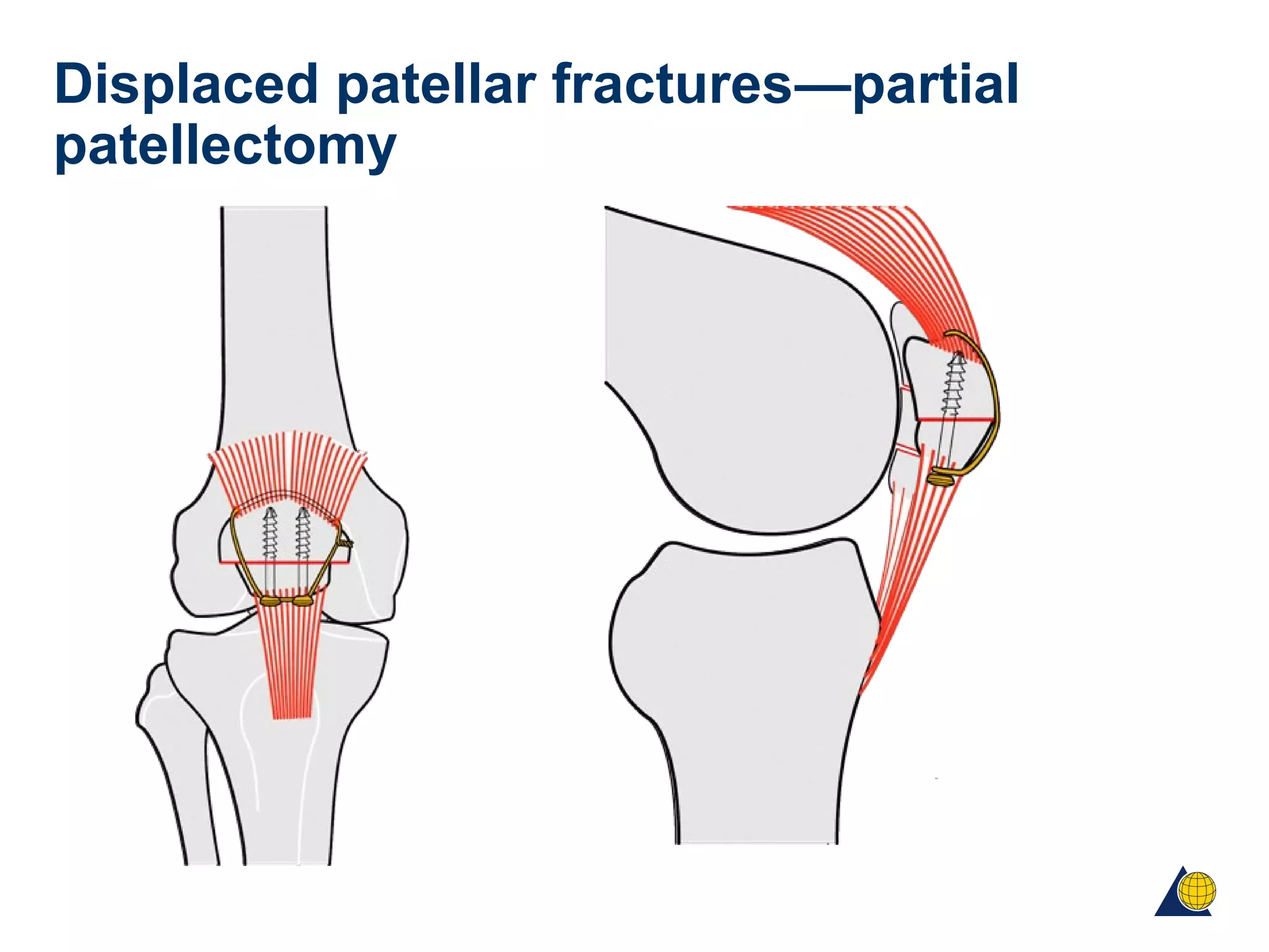 Displaced patellar fractures—partial
patellectomy
 