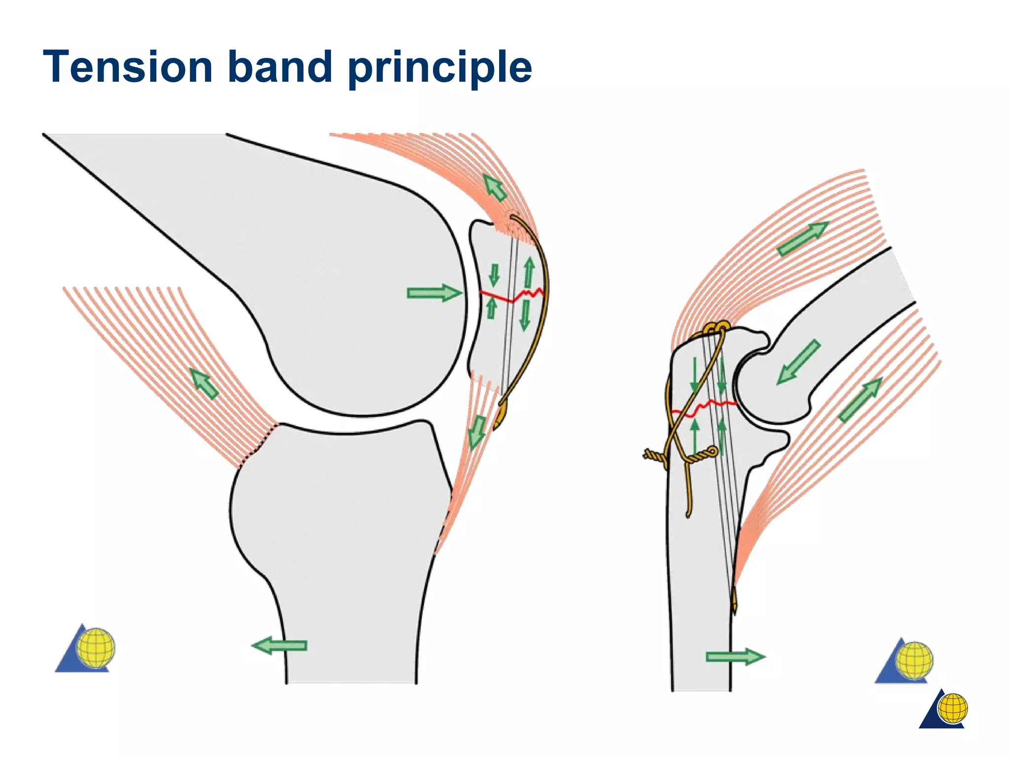Tension band principle
 