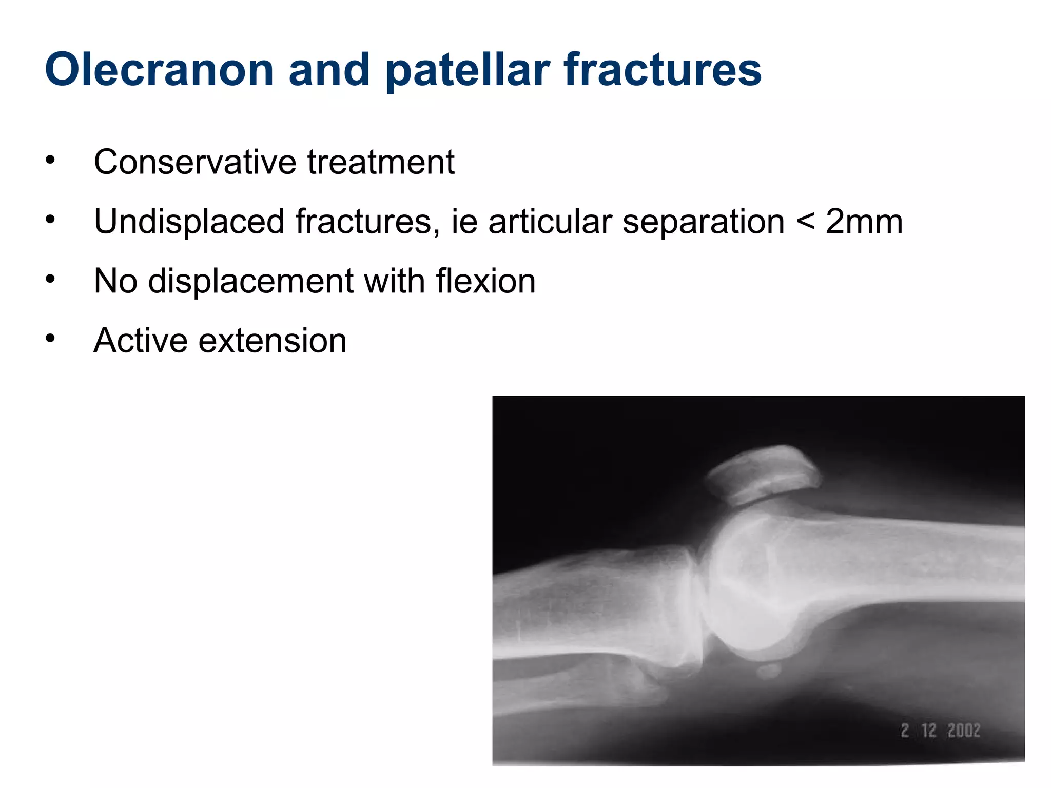 Olecranon and patellar fractures
• Conservative treatment
• Undisplaced fractures, ie articular separation < 2mm
• No displacement with flexion
• Active extension
 