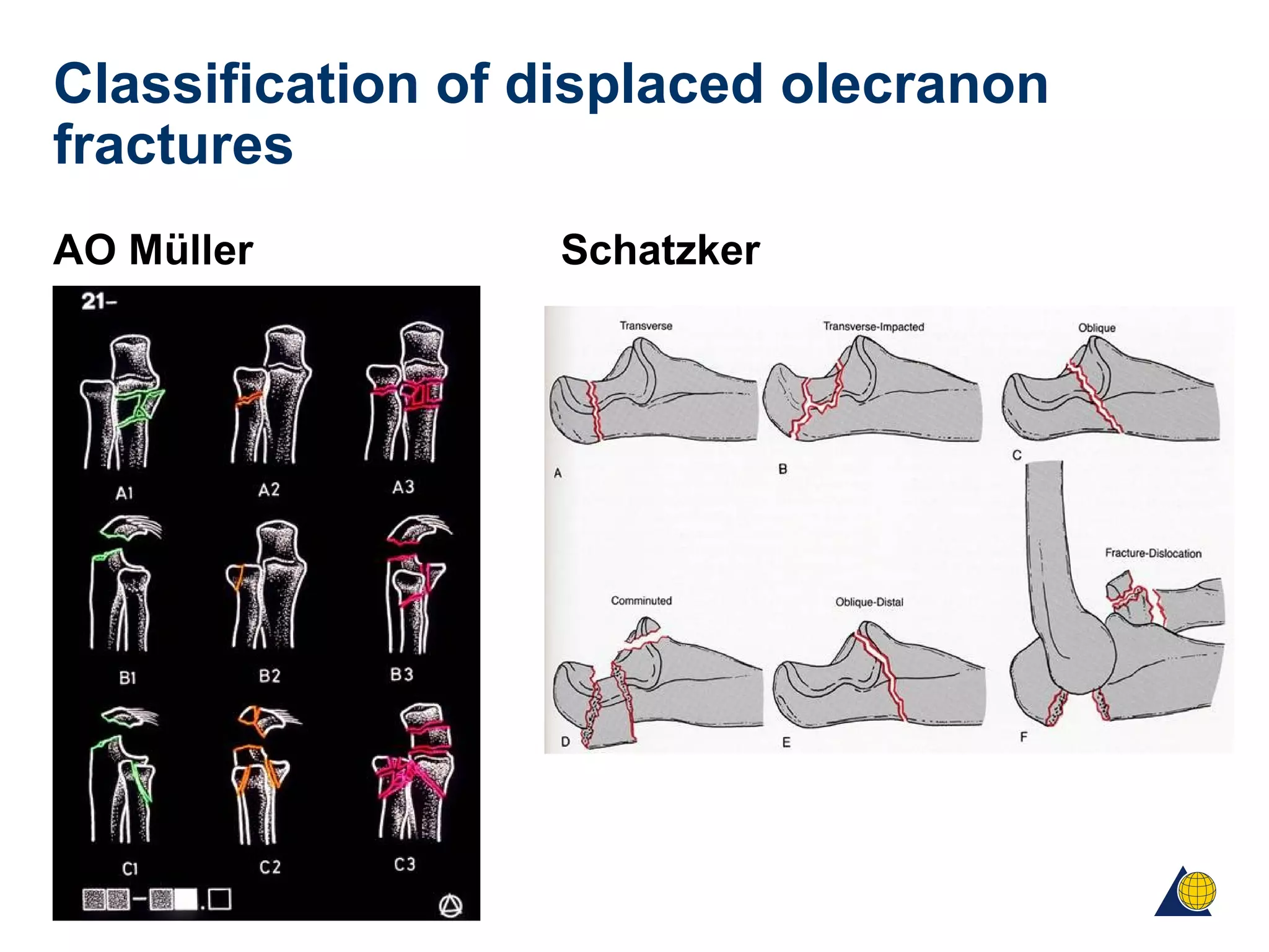 Classification of displaced olecranon
fractures
AO Müller Schatzker
 