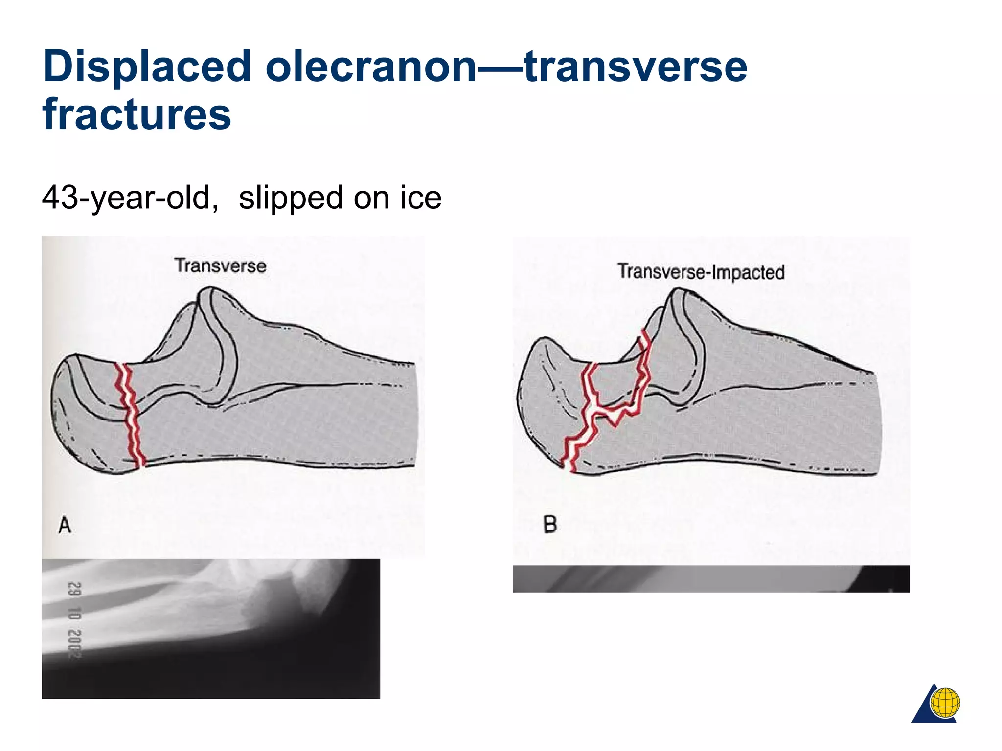 Displaced olecranon—transverse
fractures
43-year-old, slipped on ice
 
