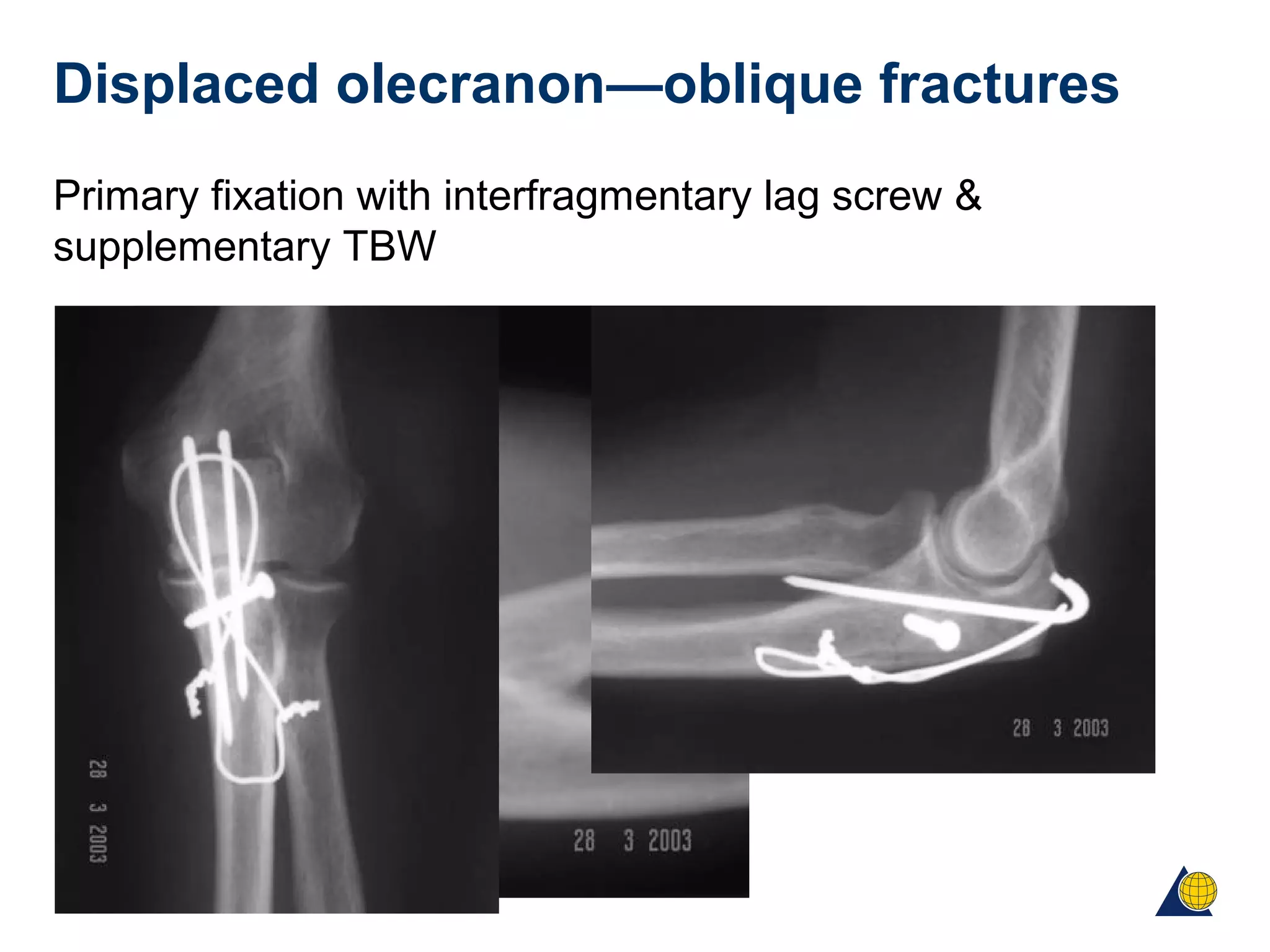 Displaced olecranon—oblique fractures
Primary fixation with interfragmentary lag screw &
supplementary TBW
 