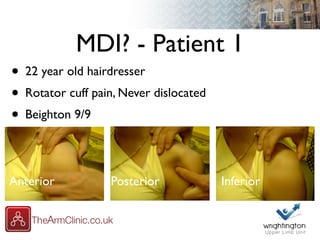 MDI? - Patient 1
• 22 year old hairdresser
• Rotator cuff pain, Never dislocated
• Beighton 9/9
Anterior InferiorPosterior
 