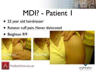 MDI? - Patient 1
• 22 year old hairdresser
• Rotator cuff pain, Never dislocated
• Beighton 9/9
Anterior InferiorPosterior
 