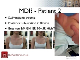 MDI? - Patient 2
• Swimmer, no trauma
• Posterior subluxation in ﬂexion
• Beighton 3/9. GHJ ER 90+, IR High Thoracic
 