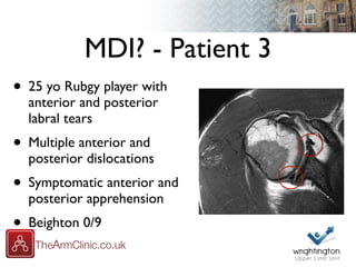 MDI? - Patient 3
• 25 yo Rubgy player with
anterior and posterior
labral tears
• Multiple anterior and
posterior dislocations
• Symptomatic anterior and
posterior apprehension
• Beighton 0/9
 