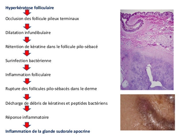 Maladie de Verneuil (hidradénite suppurée): rationnel Maladie de Verneuil (hidradénite suppurée): rationnel