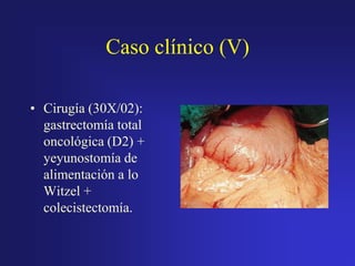 Caso clínico (V)
• Cirugía (30X/02):
gastrectomía total
oncológica (D2) +
yeyunostomía de
alimentación a lo
Witzel +
colecistectomía.

 