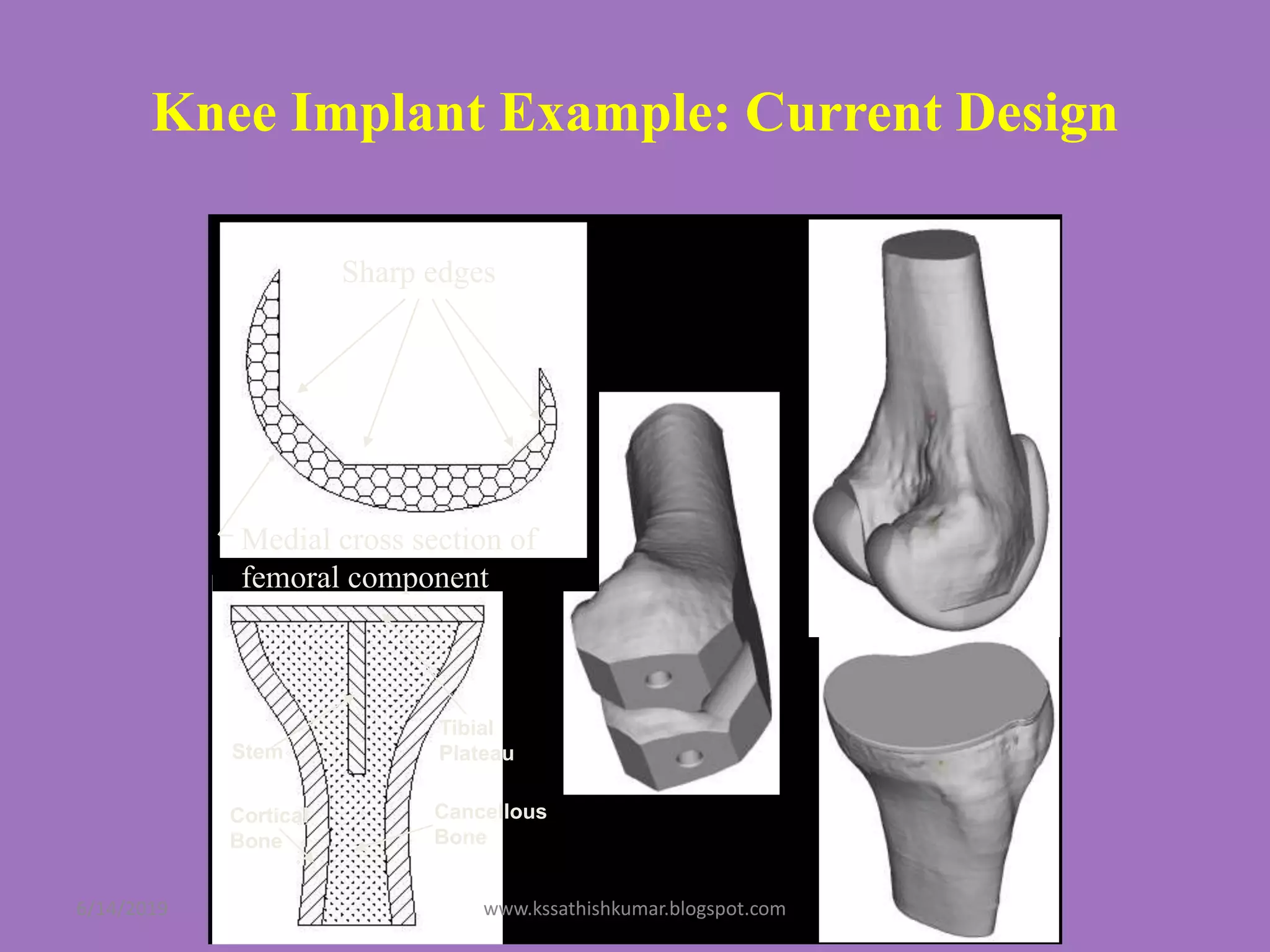 Knee Implant Example: Current Design
Cancellous
Bone
Cortical
Bone
Tibial
PlateauStem
Sharp edges
Medial cross section of
femoral component
6/14/2019 www.kssathishkumar.blogspot.com
 