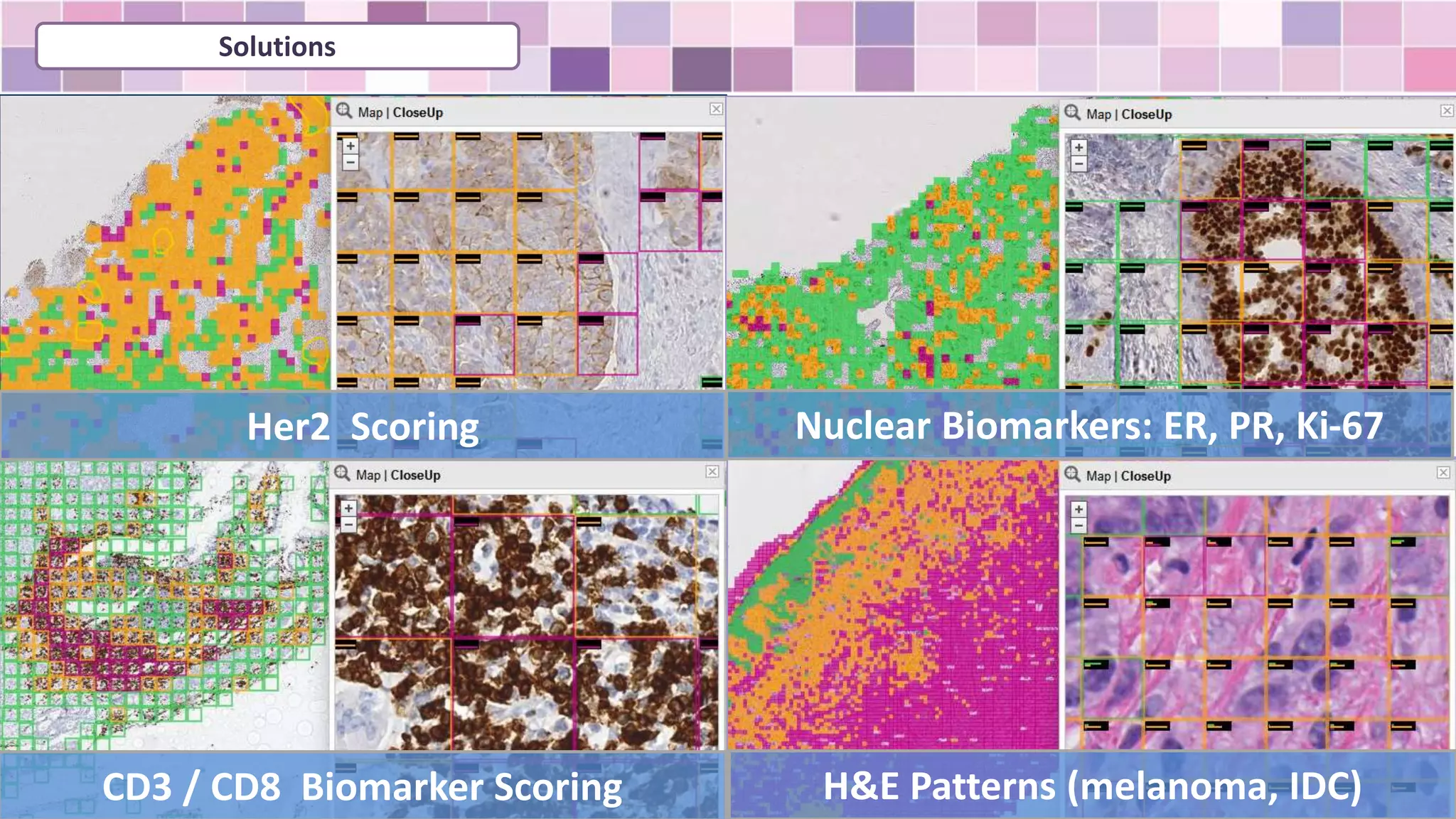 Solutions
Her2 Scoring Nuclear Biomarkers: ER, PR, Ki-67
CD3 / CD8 Biomarker Scoring H&E Patterns (melanoma, IDC)
 