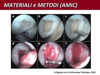 MATERIALI e METODI (AMIC)MATERIALI e METODI (AMIC)
A.Gigante et al. Arthroscopy Technique, 2012
 