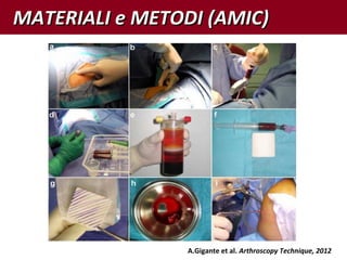 MATERIALI e METODI (AMIC)MATERIALI e METODI (AMIC)
A.Gigante et al. Arthroscopy Technique, 2012
 