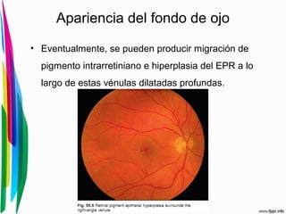 Apariencia del fondo de ojo
• Eventualmente, se pueden producir migración de
pigmento intrarretiniano e hiperplasia del EPR a lo
largo de estas vénulas dilatadas profundas.
 