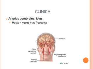CLINICA


Arterias cerebrales: ictus.


Hasta 4 veces mas frecuente

 