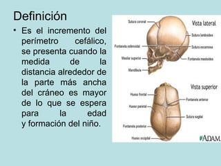 Definición Es el incremento del perímetro cefálico, se presenta cuando la medida de la distancia alrededor de la parte más ancha del cráneo es mayor de lo que se espera para la edad y formación del niño.
