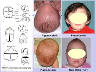 Trigonocefalia Braquicefalia
Plagiocefalia Oxicefalia (Turri)
 