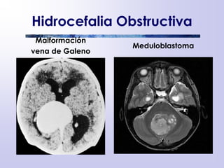 Hidrocefalia Obstructiva
Malformación
vena de Galeno
Meduloblastoma
 