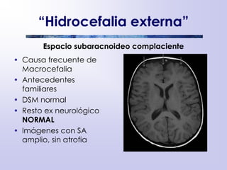 “Hidrocefalia externa”
Espacio subaracnoideo complaciente
• Causa frecuente de
Macrocefalia
• Antecedentes
familiares
• DSM normal
• Resto ex neurológico
NORMAL
• Imágenes con SA
amplio, sin atrofia
 
