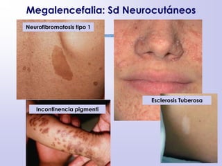 Megalencefalia: Sd Neurocutáneos
Neurofibromatosis tipo 1
Esclerosis Tuberosa
Incontinencia pigmenti
 