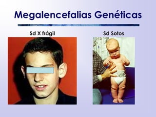 Megalencefalias Genéticas
Sd X frágil Sd Sotos
 