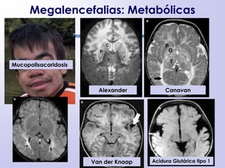 Megalencefalias: Metabólicas
Mucopolisacaridosis
Van der Knaap
CanavanAlexander
Acidura Glutárica tipo 1
 