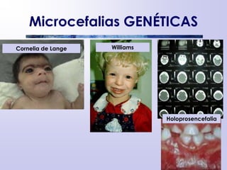 Microcefalias GENÉTICAS
Cornelia de Lange Williams
Holoprosencefalia
 