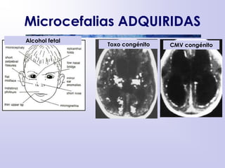 Microcefalias ADQUIRIDAS
!
Imagen extraída de www.fetalalcohol.com/images
prevenir en un 100%, si las mujeres dejasen de consumir alcohol antes de concebir o
exista la posibilidad de una gestación.
n y el consejo genético preconcepcional no solo en mujeres alcohólicas inveteradas.
exposición fetal a alcohol asociada al uso de drogas de abuso (Cocaina) y a
s como sífilis, en embarazadas adictas, así como el síndrome de abstinencia en el
liar sus conocimientos de teratología puede consultar la página siguiente:
http://en.wikipedia.org/wiki/Fetal_alcohol_syndrome
Alcohol fetal
Toxo congénito CMV congénito
 