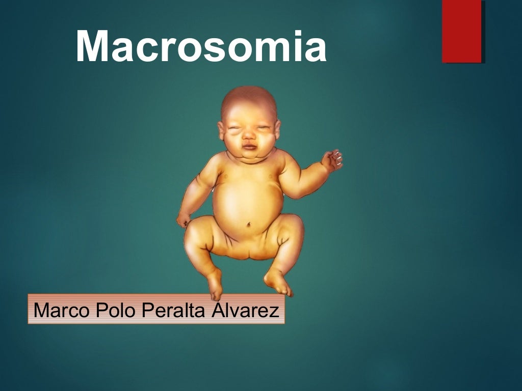 Macrosomia