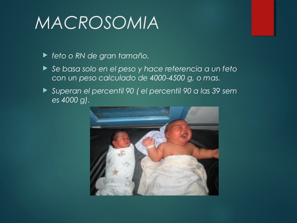 Macrosomia