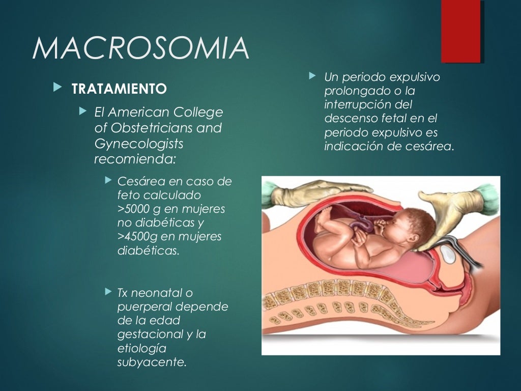 Macrosomia